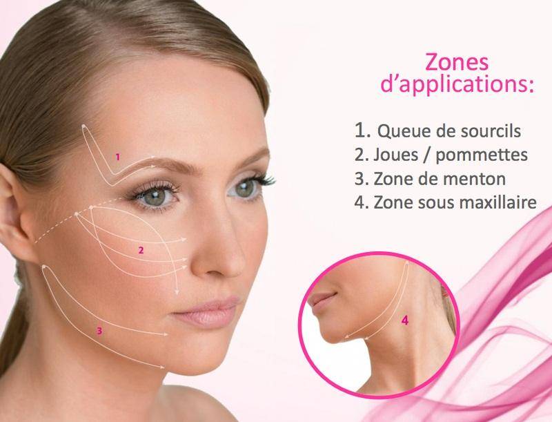 Pose de fils tenseurs pour lutter contre le relâchement cutané sur Carry le Rouet