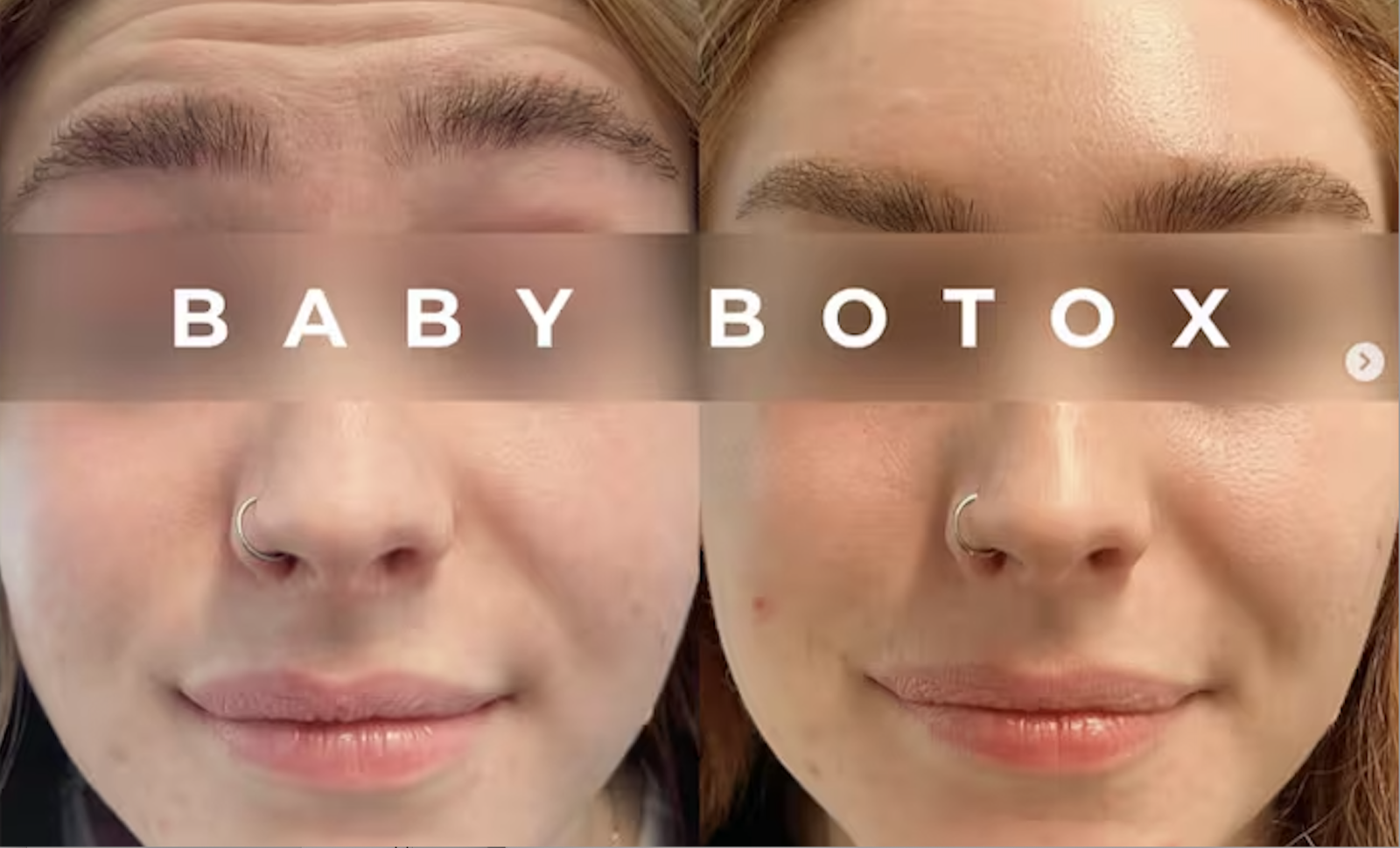 Baby Botox au Centre Jouvence à Carry-le-Rouet : Une Solution Anti-Âge Innovante