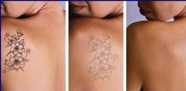 Centre laser picoseconde spécialisé dans le Détatouage sur CARRY LE ROUET