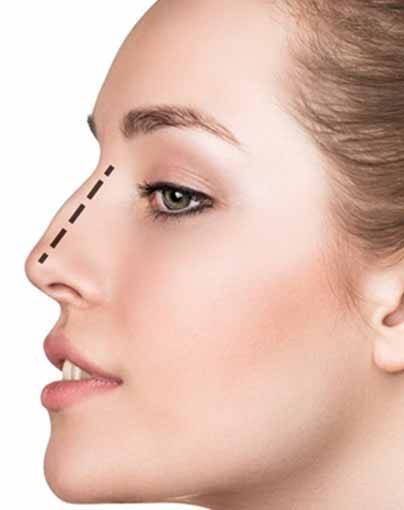 Rhinoplastie médicale ou chirurgicale à Marseille