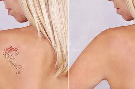 Spécialiste détatouage médical picosure Marseille