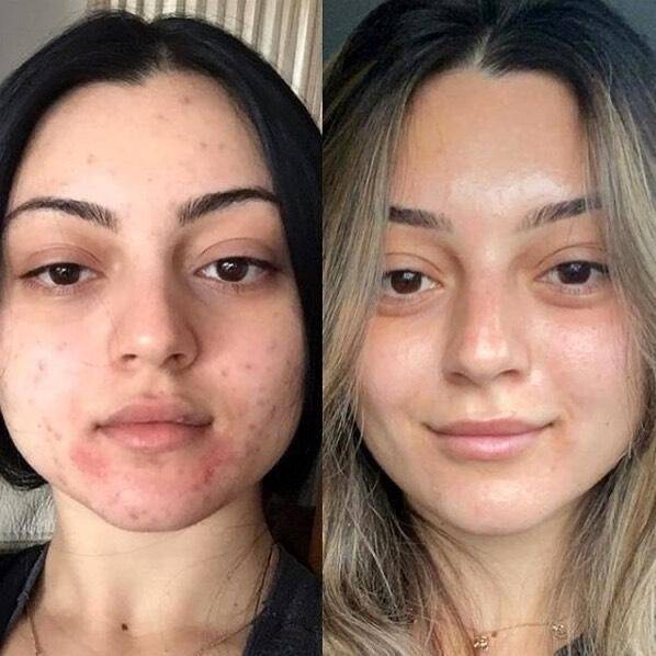 Traitement de l'Acné Bactérienne par IPL au Centre Jouvence à Carry-le-Rouet : Une Solution Innovante pour Visage, Dos et Décolleté