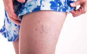 Laser vasculaire pour traiter vaisseaux sur les jambes