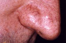 Laser Vasculaire pour traiter les vaisseaux jambes, visage et nez à Martigues