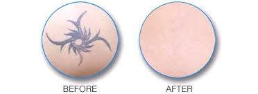 Meilleur laser picoseconde pour détatouage Marseille dans les bouches du rhône