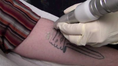 Notre zone d'activité pour ce service Centre laser pour détatouage