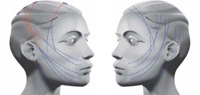 Notre zone d'activité pour ce service Pose de fils tenseurs contre le relâchement cutané