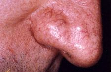 Notre zone d'activité pour ce service Chirurgie du contour des yeux blépharoplastie